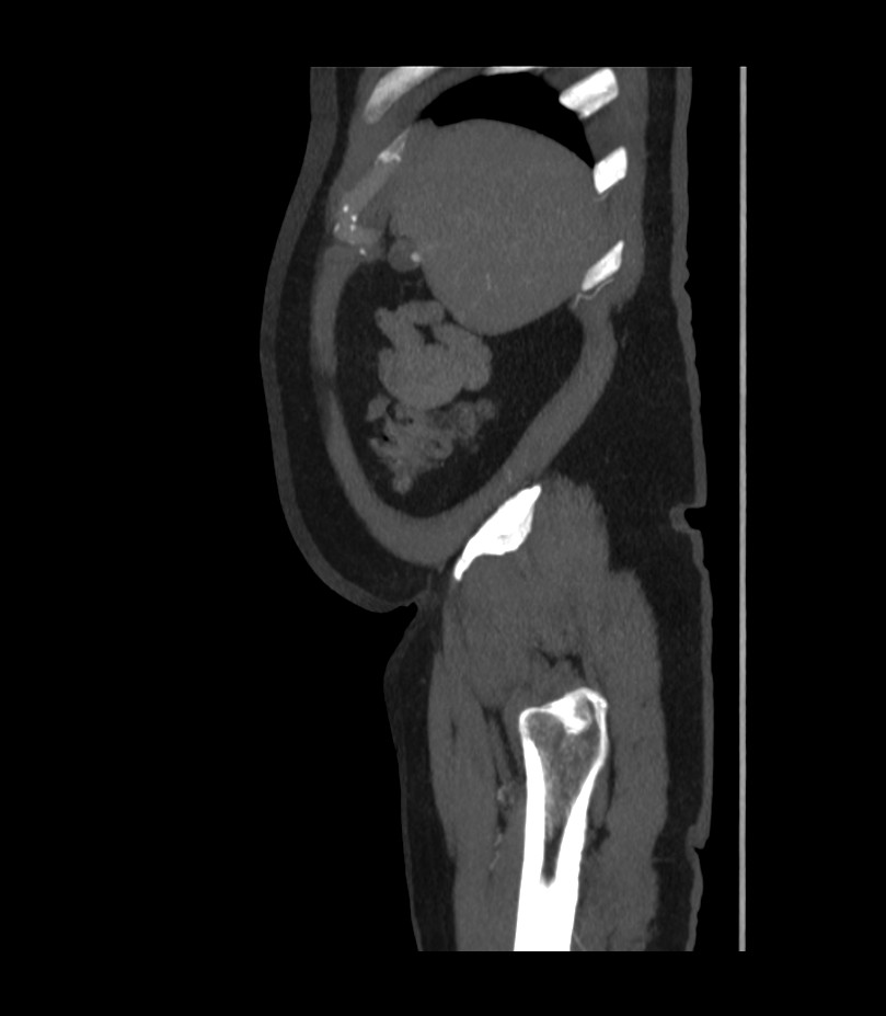 Abdominal aortic aneurysm with thrombus fissuration (Radiopaedia 46218-50618 Sagittal C+ arterial phase 6).jpg