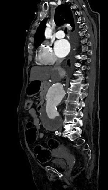 Abdominal aortic aneurysm with thrombus fissuration (Radiopaedia 73192-83919 Sagittal C+ arterial phase 77).jpg