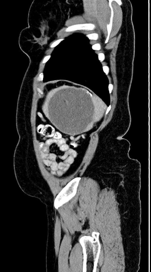 Abdominal hydatid disease (Radiopaedia 68223-77737 Sagittal C+ portal venous phase 8).jpg
