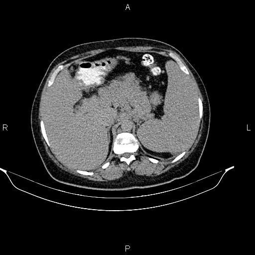 Abdominal lymphoma with sandwich sign (Radiopaedia 84378-99704 Axial C+ delayed 12).jpg