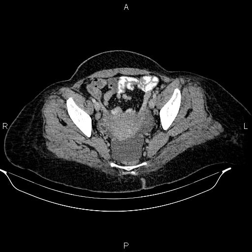 Abdominal lymphoma with sandwich sign (Radiopaedia 84378-99704 Axial C+ portal venous phase 50).jpg