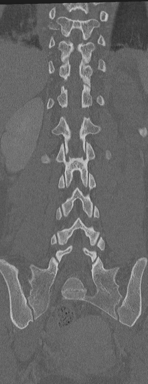 Abdominal multi-trauma - devascularised kidney and liver, spleen and pancreatic lacerations (Radiopaedia 34984-36486 Coronal bone window 47).png