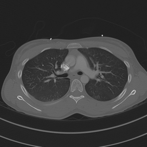 File:Abdominal multi-trauma - devascularised kidney and liver, spleen and pancreatic lacerations (Radiopaedia 34984-36486 I 34).png