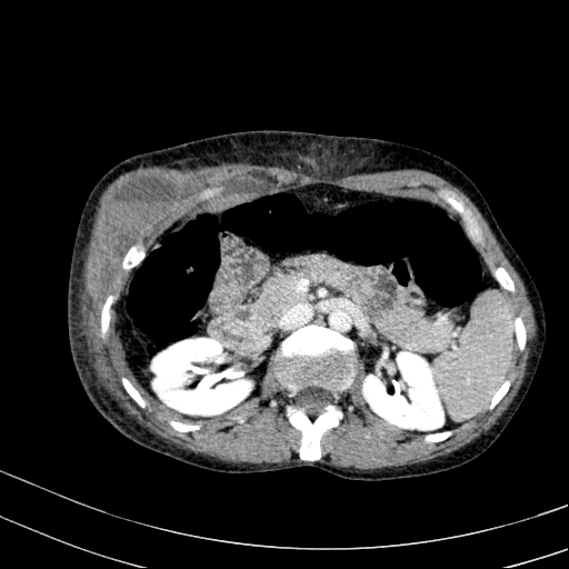 Abdominal wall hematoma with active bleeding (Radiopaedia 83915-99117 Axial C+ portal venous phase 18).jpg