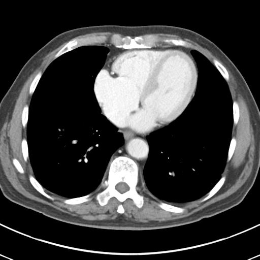 Abdominal wall metastasis from colorectal carcinoma (Radiopaedia 31016-31717 Axial C+ portal venous phase 6).jpg
