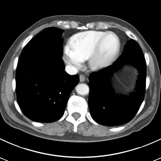 Abdominal wall metastasis from colorectal carcinoma (Radiopaedia 31016-31717 Axial C+ portal venous phase 9).jpg