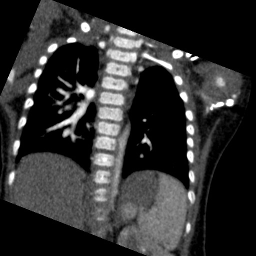 File:Aberrant left pulmonary artery (pulmonary sling) (Radiopaedia 42323-45435 Coronal C+ CTPA 9).jpg