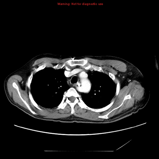 File:Aberrant right subclavian artery (Radiopaedia 9379-10071 Axial C+ arterial phase 18).jpg