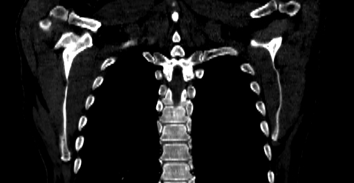 Accesory rib joint (Radiopaedia 71987-82452 Coronal bone window 51).jpg