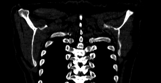 Accesory rib joint (Radiopaedia 71987-82452 Coronal bone window 73).jpg