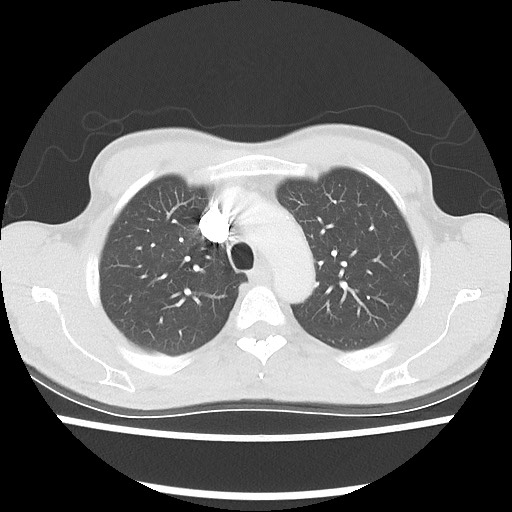 Accessory left horizontal fissure with lingular pneumonia (Radiopaedia 53763-59843 Axial lung window 17).jpg