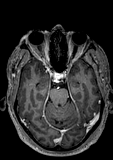 File:Accessory middle cerebral artery (Radiopaedia 73114-83828 Axial T1 C+ 92).jpg