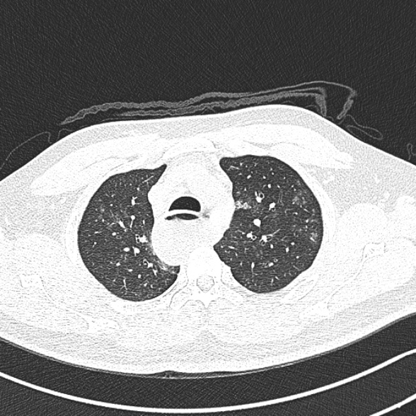Achalasia with aspiration (Radiopaedia 55413-61845 Axial lung window 16).jpg
