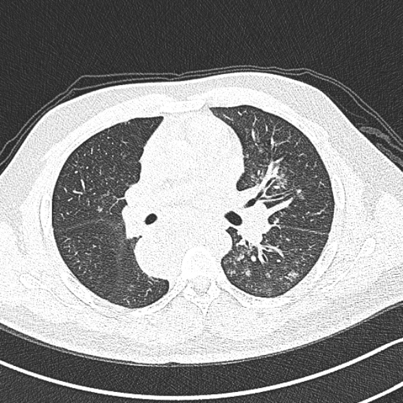 File:Achalasia with aspiration (Radiopaedia 55413-61845 Axial lung window 33).jpg
