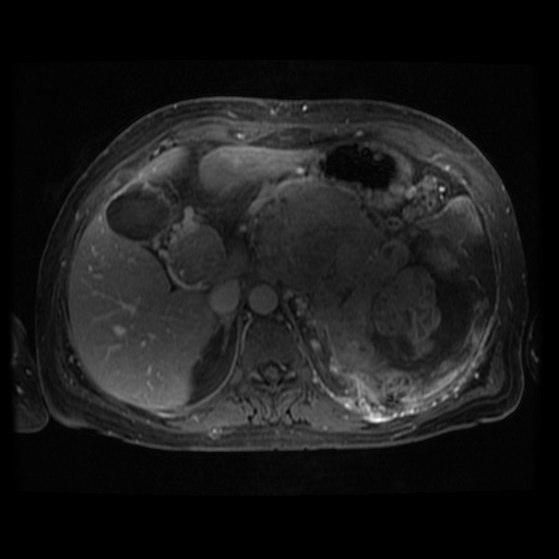Acinar cell carcinoma of the pancreas (Radiopaedia 75442-86668 Axial T1 C+ fat sat 81).jpg