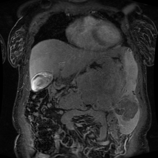 Acinar cell carcinoma of the pancreas (Radiopaedia 75442-86668 Coronal T1 C+ fat sat 135).jpg