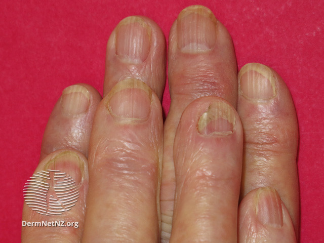 File:Acitretin nail thinning (DermNet NZ treatments-acitretin-nails).jpg
