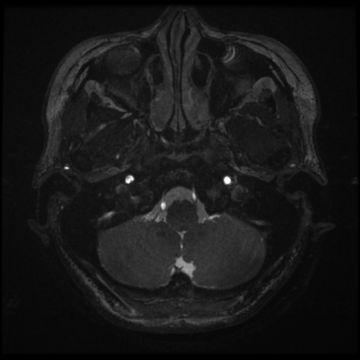 Acoustic neuroma (Radiopaedia 34049-35283 Axial 10).png