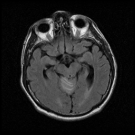 File:Acoustic schwannoma (Radiopaedia 39170-41387 Axial FLAIR 9).png