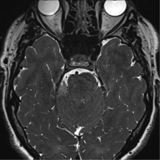 File:Acoustic schwannoma (Radiopaedia 50846-56358 Axial T2 32).png