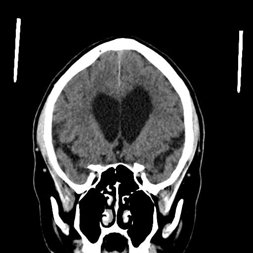 File:Acoustic schwannoma (Radiopaedia 55729-62280 Coronal non-contrast 16).png