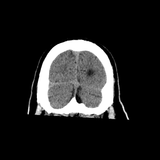 File:Acoustic schwannoma (Radiopaedia 55729-62280 Coronal non-contrast 36).png