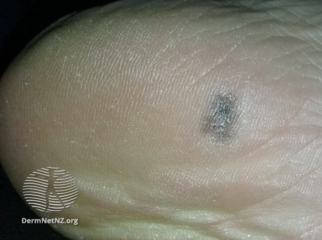 File:Acral lentiginous melanoma 0.95 mm (DermNet NZ 20160516-165502).jpg