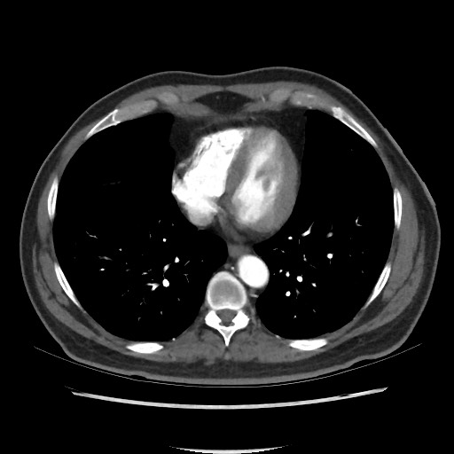 Active colonic bleed on CT (Radiopaedia 49765-55025 Axial C+ arterial phase 4).jpg