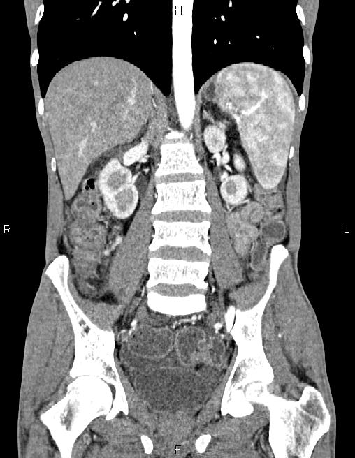 Active crohn disease (Radiopaedia 87133-103397 Coronal C+ arterial phase 40).jpg