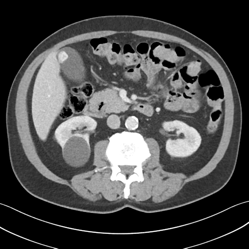 File:Active diverticular hemorrhage (Radiopaedia 39415-41725 Axial C+ portal venous phase 28).png
