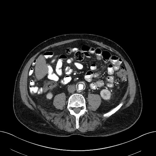 File:Active lower gastrointestinal bleeding - diverticular (Radiopaedia 61203-69106 Axial C+ arterial phase 1).jpg