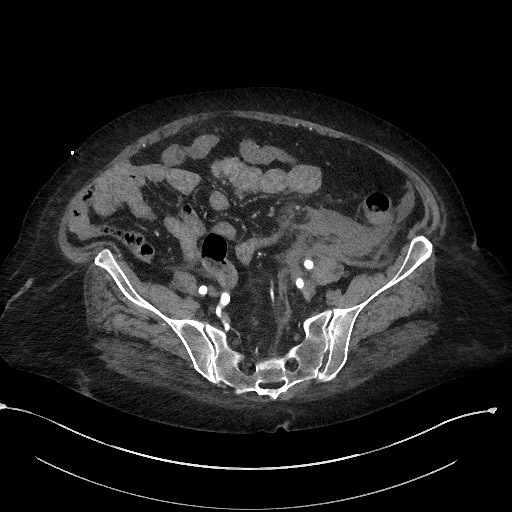 File:Active renal extravasation with large subcapsular and retroperitoneal hemorrhage (Radiopaedia 60975-68796 Axial C+ arterial phase 144).jpg