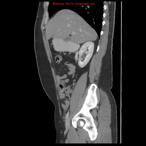 File:Acute appendicitis (Radiopaedia 10498-10973 Sagittal C+ portal venous phase 7).jpg