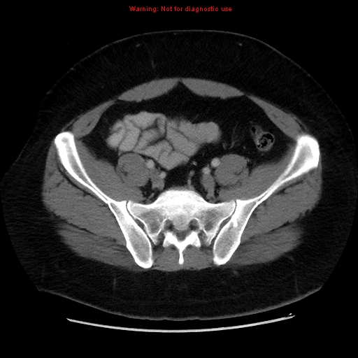 File:Acute appendicitis (Radiopaedia 12326-12607 Axial C+ portal venous phase 39).jpg