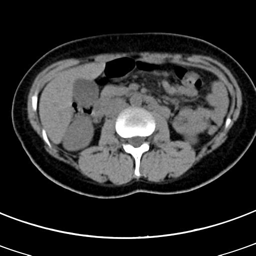Acute appendicitis (Radiopaedia 30261-30888 Axial non-contrast 31).jpg