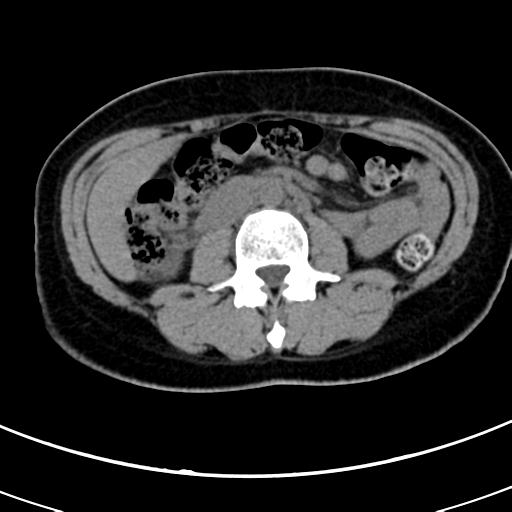 Acute appendicitis (Radiopaedia 30261-30888 Axial non-contrast 37).jpg