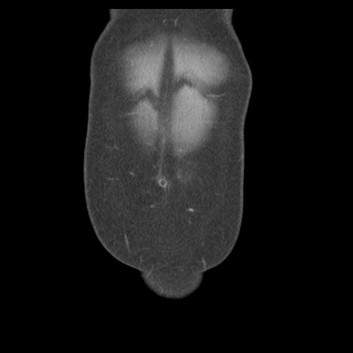 File:Acute appendicitis (Radiopaedia 30297-30934 Coronal C+ portal venous phase 4).jpg