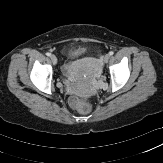 File:Acute appendicitis (Radiopaedia 48792-53822 Axial C+ portal venous phase 106).jpg