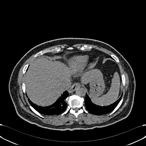 Acute appendicitis (Radiopaedia 58627-65818 Axial non-contrast 12).jpg