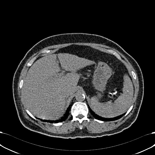 Acute appendicitis (Radiopaedia 58627-65818 Axial non-contrast 21).jpg
