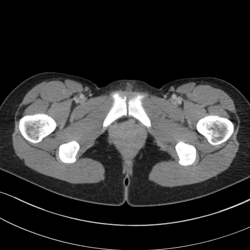 File:Acute appendicitis (Radiopaedia 62608-70901 Axial C+ portal venous phase 69).jpg