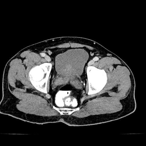 Acute appendicitis (Radiopaedia 77016-88960 Axial C+ portal venous phase 131).jpg