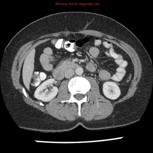 File:Acute appendicitis (Radiopaedia 7966-8812 C+ portal venous phase 18).jpg
