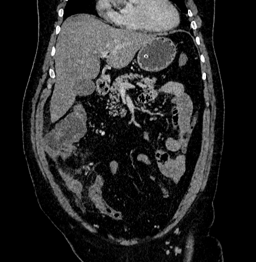 Acute appendicitis (Radiopaedia 79950-93224 Coronal C+ portal venous phase 32).jpg