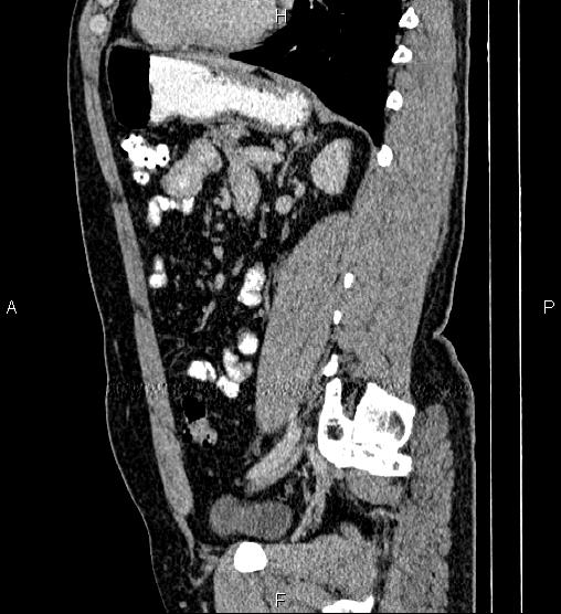 File:Acute appendicitis (Radiopaedia 84780-100240 Sagittal C+ portal venous phase 67).jpg