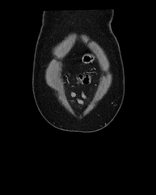 Acute appendicitis - large appendicoliths (Radiopaedia 61805-69820 Coronal C+ portal venous phase 15).jpg