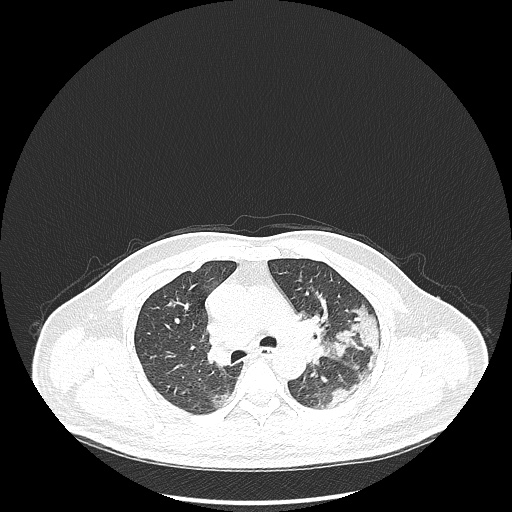 Acute appendicitis and COVID 19 pneumonia (Radiopaedia 76604-88380 Axial lung window 22).jpg