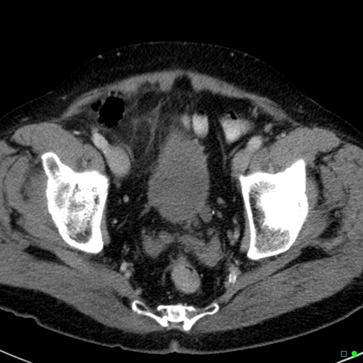 File:Acute appendicitis arising from a malrotated cecum (Radiopaedia 19970-19997 Axial C+ portal venous phase 44).jpg