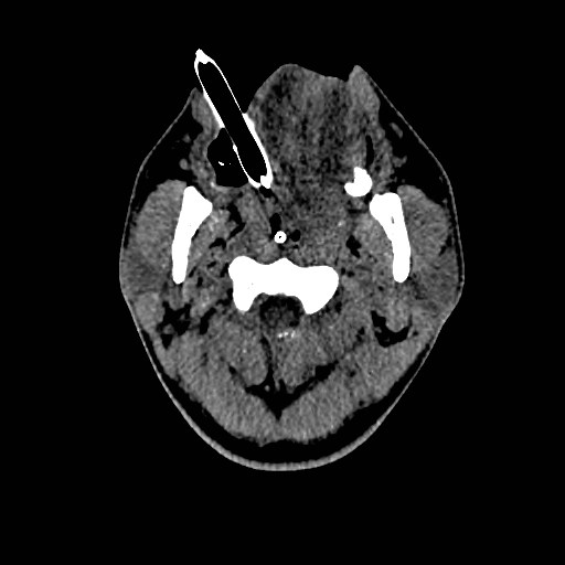 Acute basilar artery occlusion (Radiopaedia 43582-46985 Axial non-contrast 3).jpg