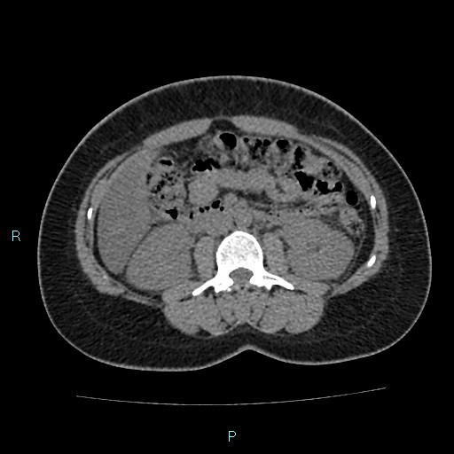 Acute bilateral pyelonephritis (Radiopaedia 37146-38881 Axial non-contrast 49).jpg